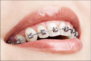 Central Park Dentist Braces Orthodontics